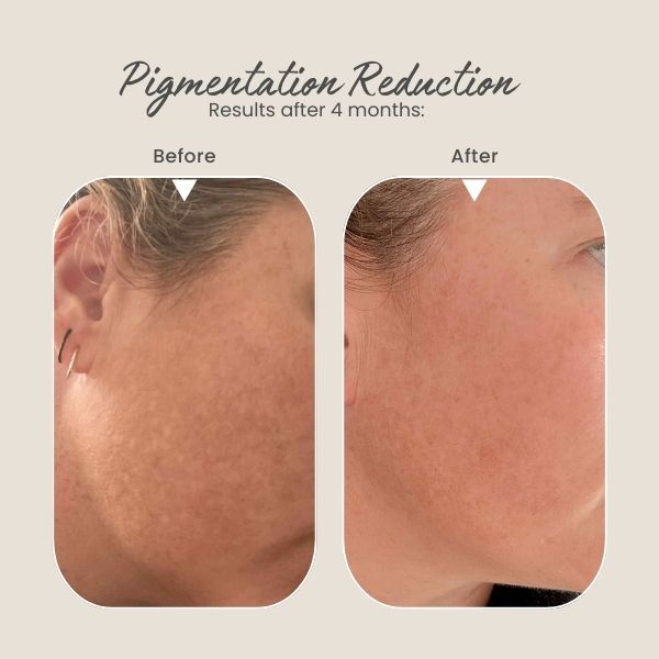 Before and after comparison of pigmentation reduction on a person's cheek.
